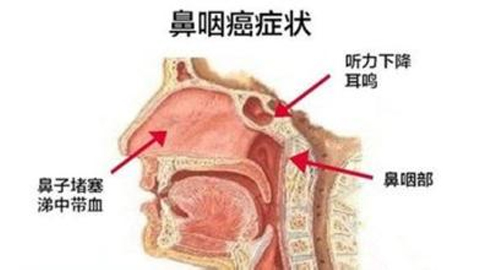 鼻咽癌初期症状有哪些